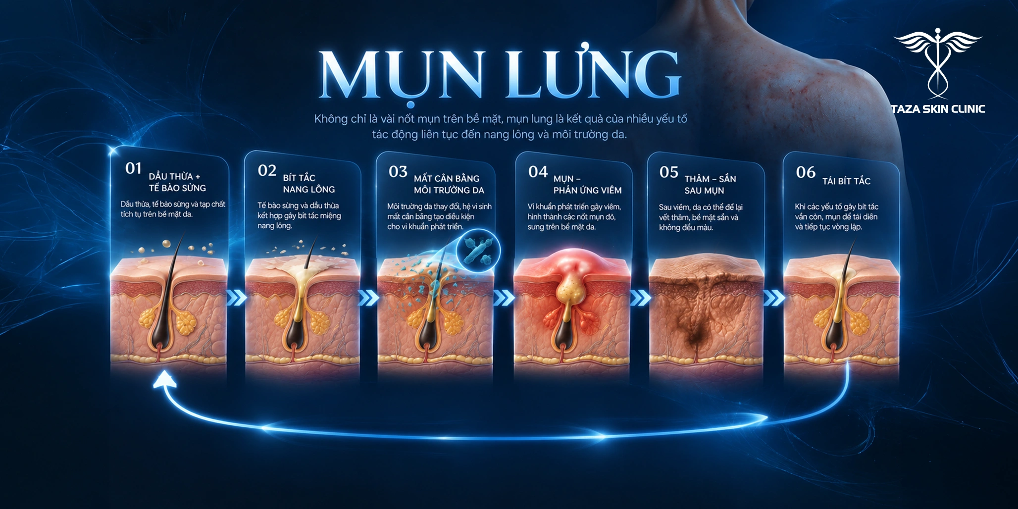 Vòng lặp hình thành mụn lưng từ bít tắc nang lông đến thâm sần