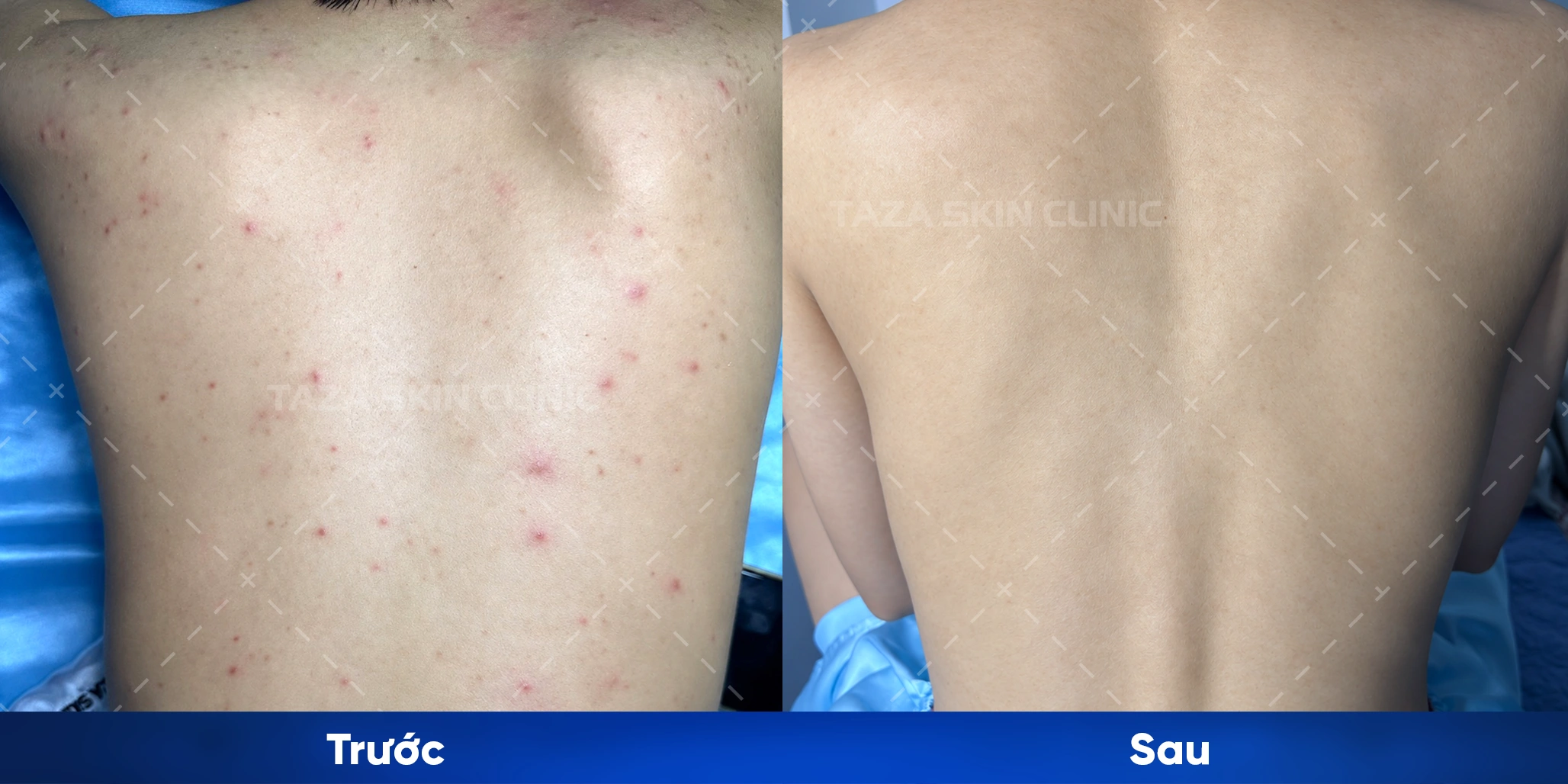Khách hàng trước và sau peel mụn lưng Fillio Bio Plus