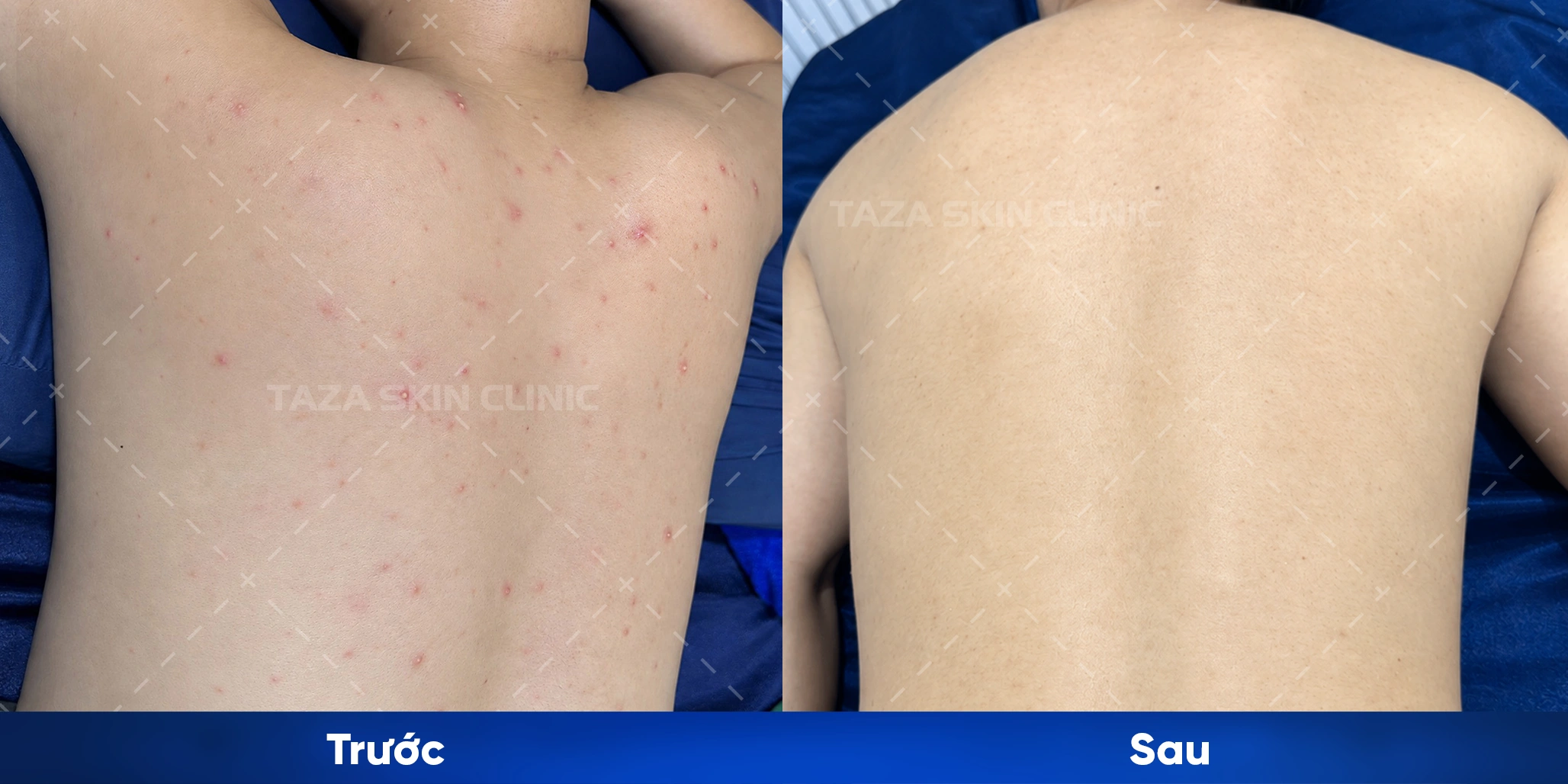 Vùng lưng và vai giảm mụn viêm sau liệu trình peel mụn lưng