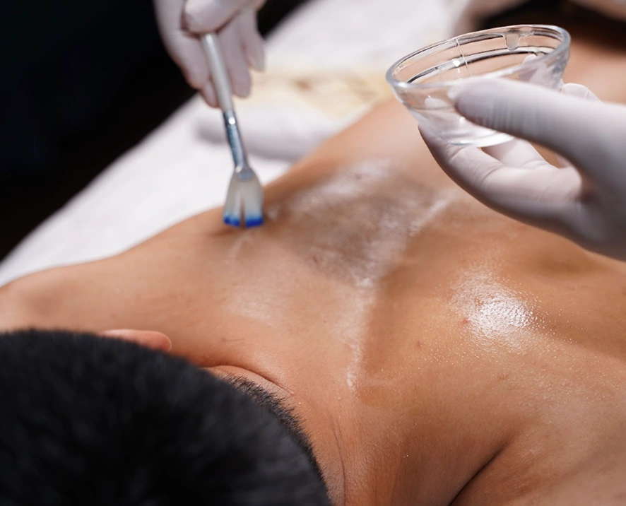 Peel mụn lưng tại Taza Skin Clinic