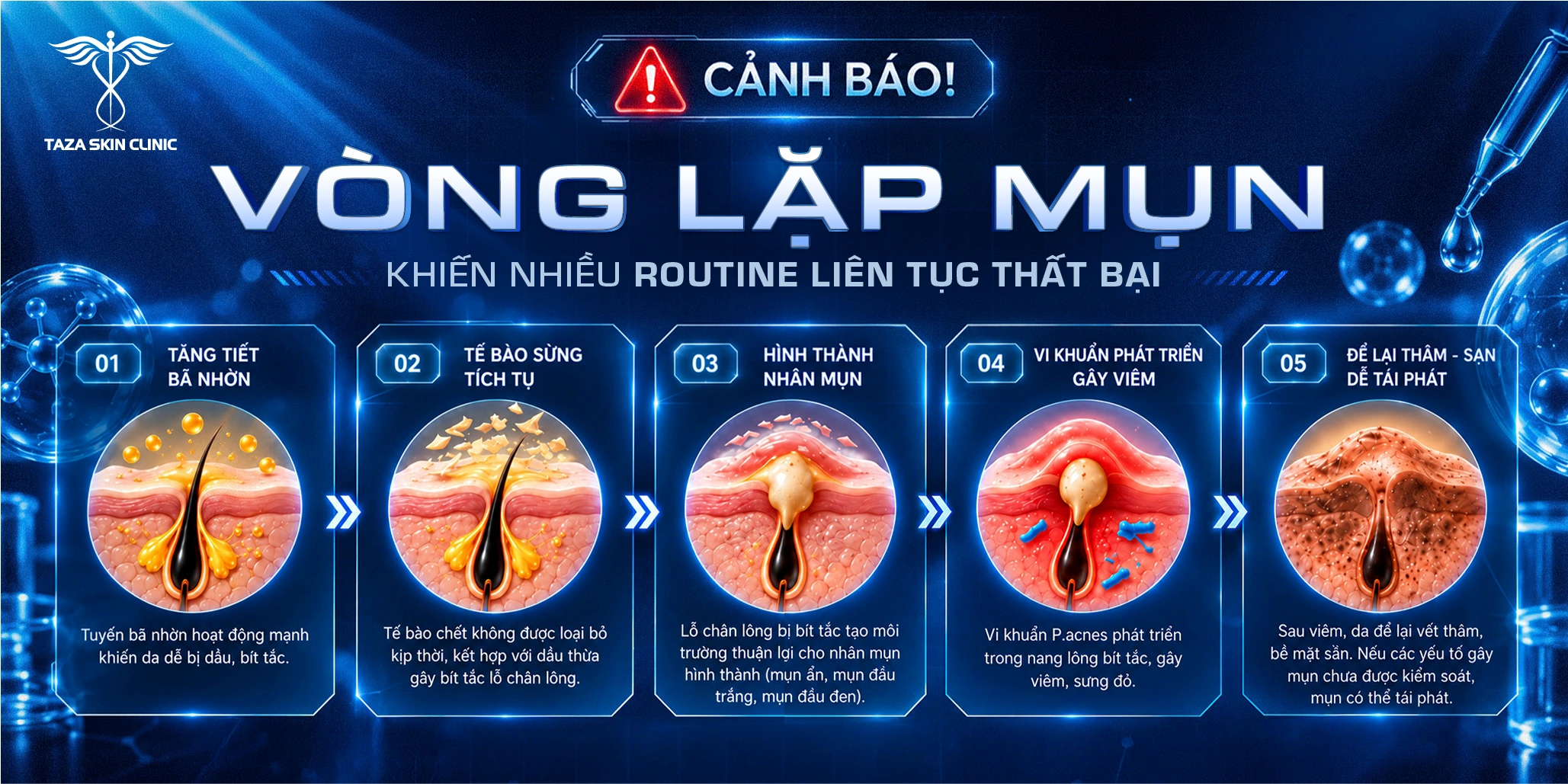 Vòng lặp mụn trên da mặt từ tăng tiết bã nhờn đến thâm sạn và tái phát