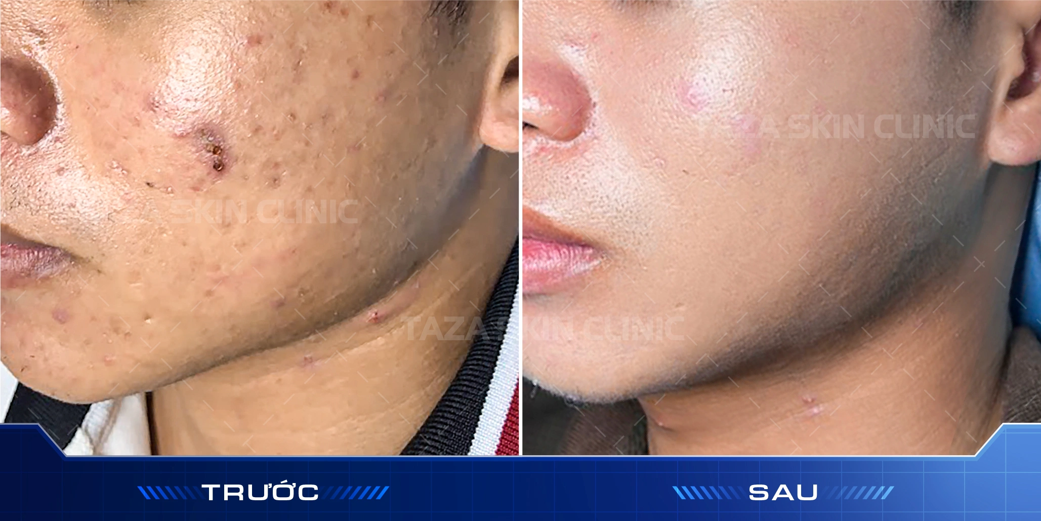Khách hàng nam trước và sau liệu trình peel mụn