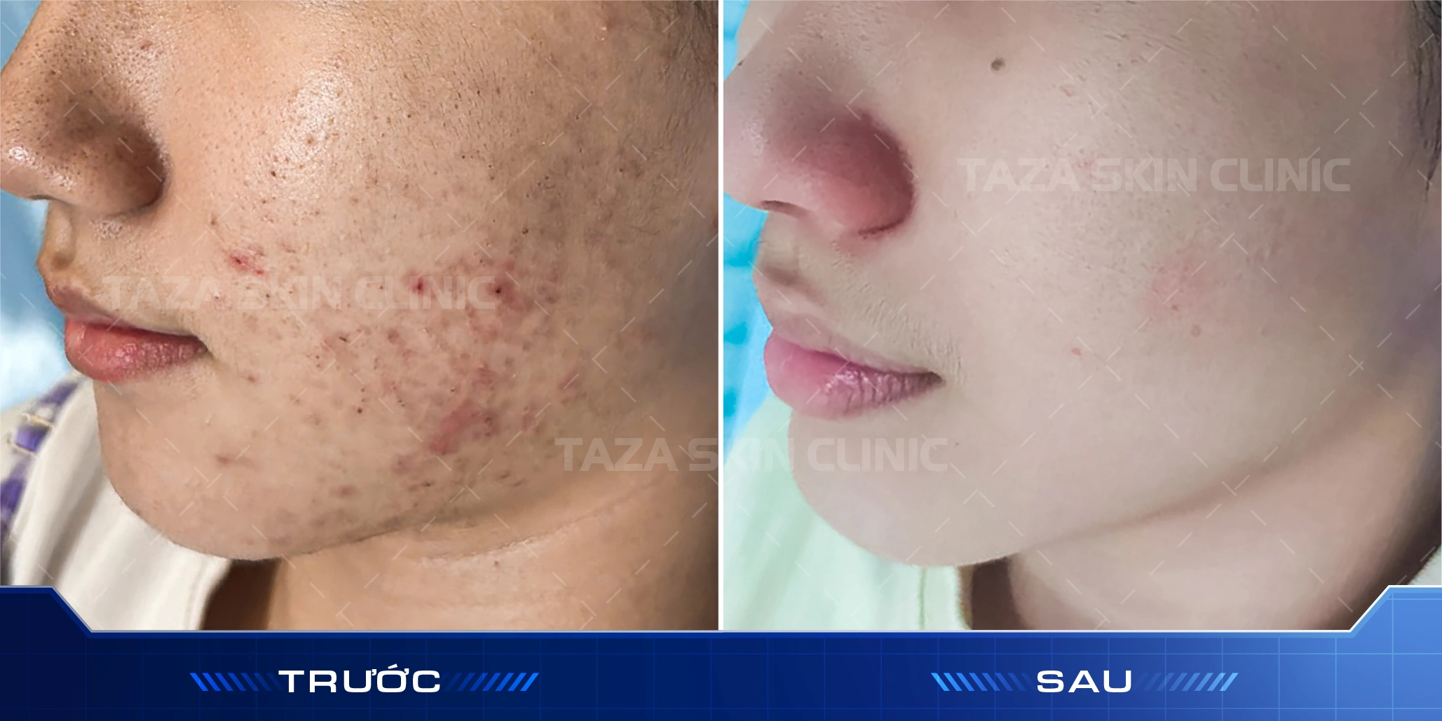 Khách hàng nữ trước và sau điều trị mụn bằng peel mụn