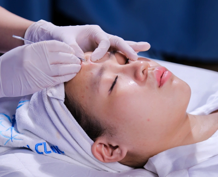 Peel mụn tại Taza Skin Clinic