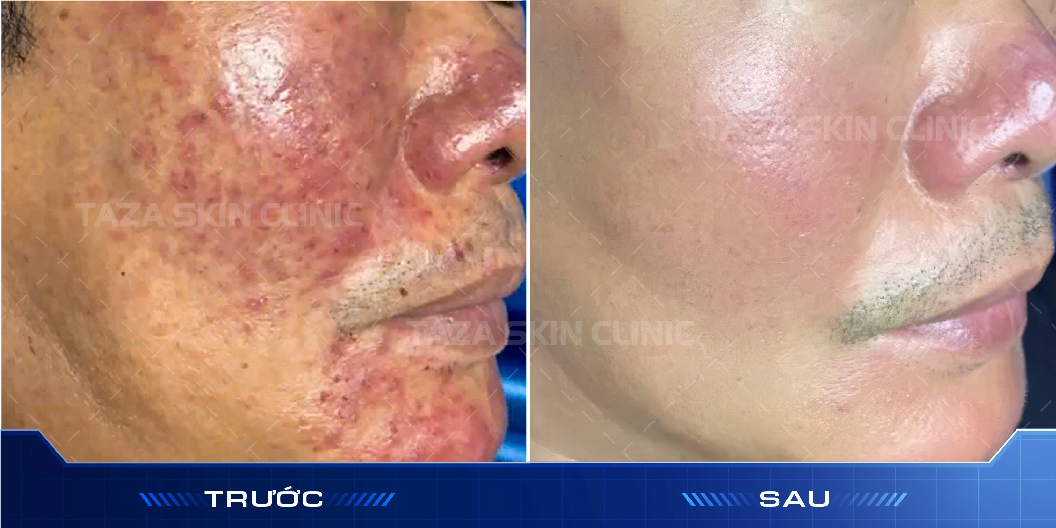 Khách hàng nam trước và sau phục hồi da nhiễm corticoid