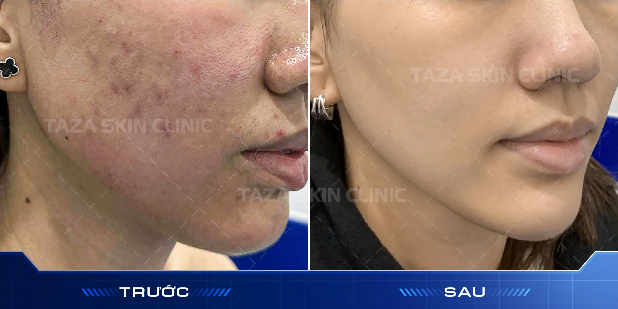 Khách hàng nữ trước và sau liệu trình Cell Reset