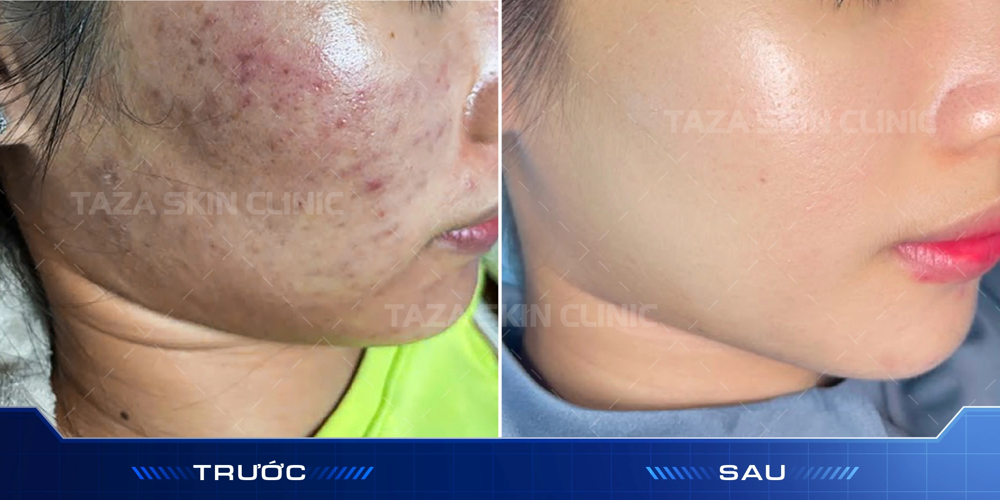 Da má giảm viêm đỏ, đều màu hơn sau phục hồi Cell Reset